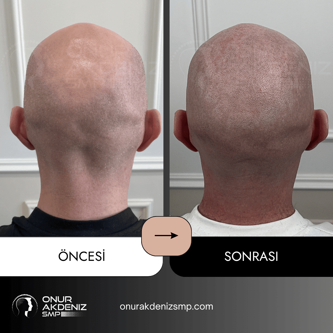 Onur Akdeniz SMP tarafindan tirasli sac gorunumu icin sac mikropigmentasyonu oncesi ve sonrasi 123