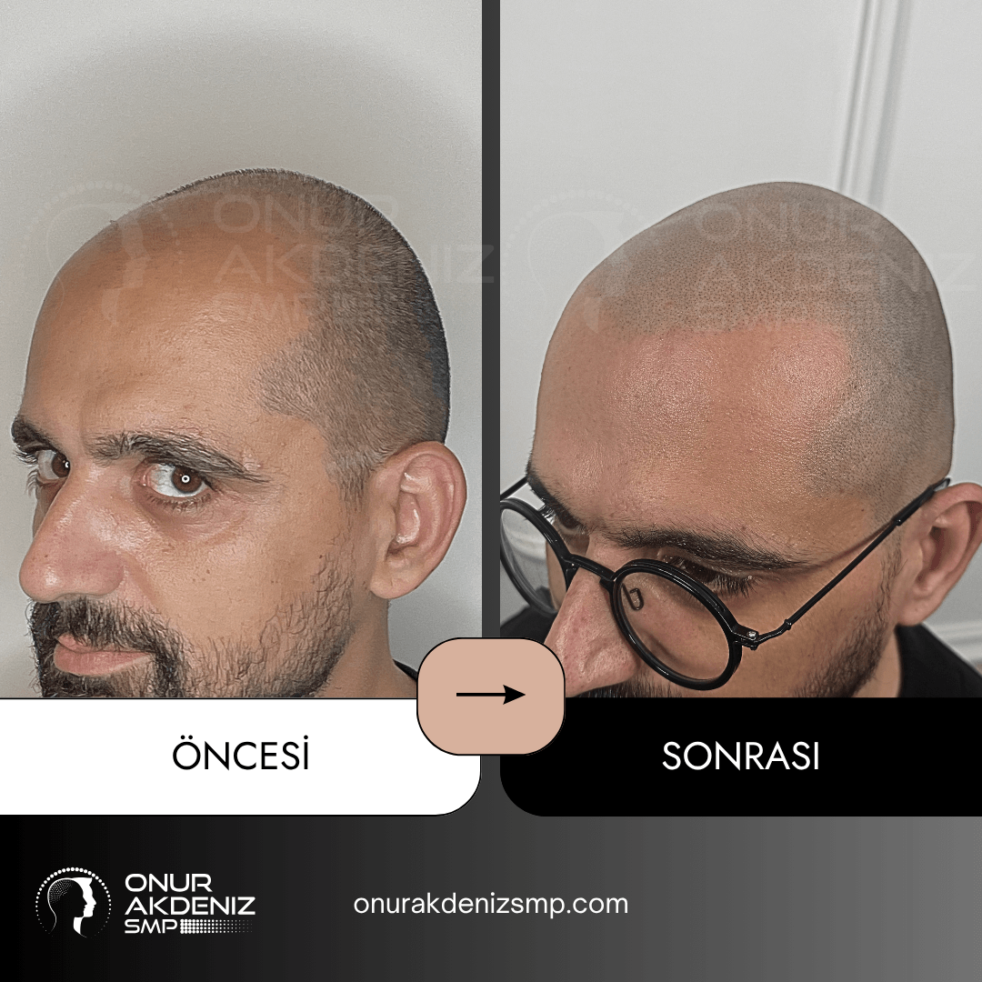 Onur Akdeniz SMP 52 Onur Akdeniz SMP tarafindan tirasli sac gorunumu icin sac mikropigmentasyonu oncesi ve sonrasi 134