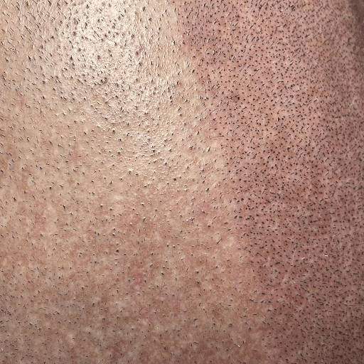 SMP for Lichen Planus 2