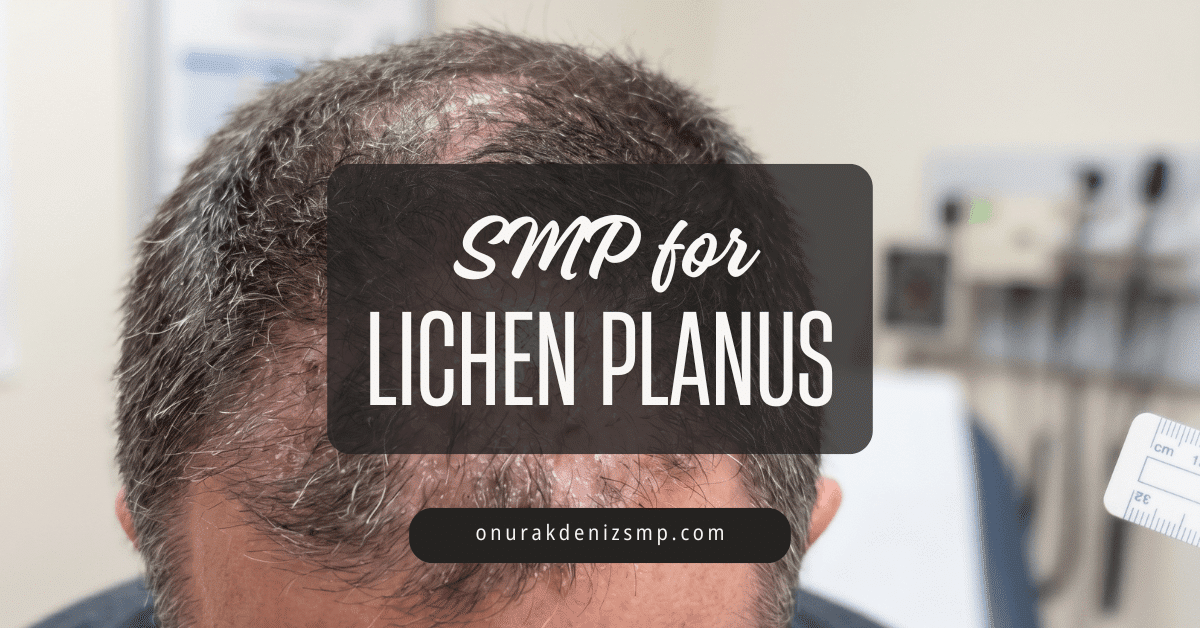SMP for Lichen Planus