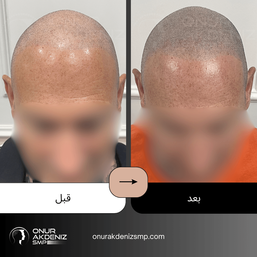 تصبغ فروة الرأس المجهري قبل وبعد للحصول على مظهر الشعر المحلوق مع أونور أكدينيز 109