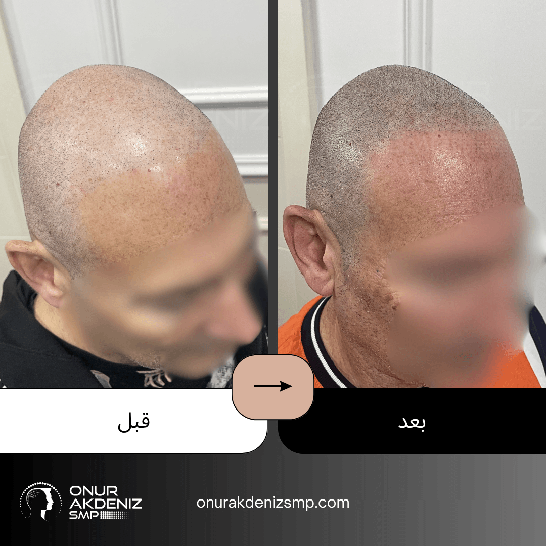تصبغ فروة الرأس المجهري قبل وبعد للحصول على مظهر الشعر المحلوق مع أونور أكدينيز 112