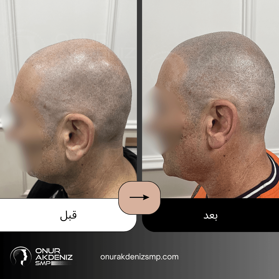 تصبغ فروة الرأس المجهري قبل وبعد للحصول على مظهر الشعر المحلوق مع أونور أكدينيز 115