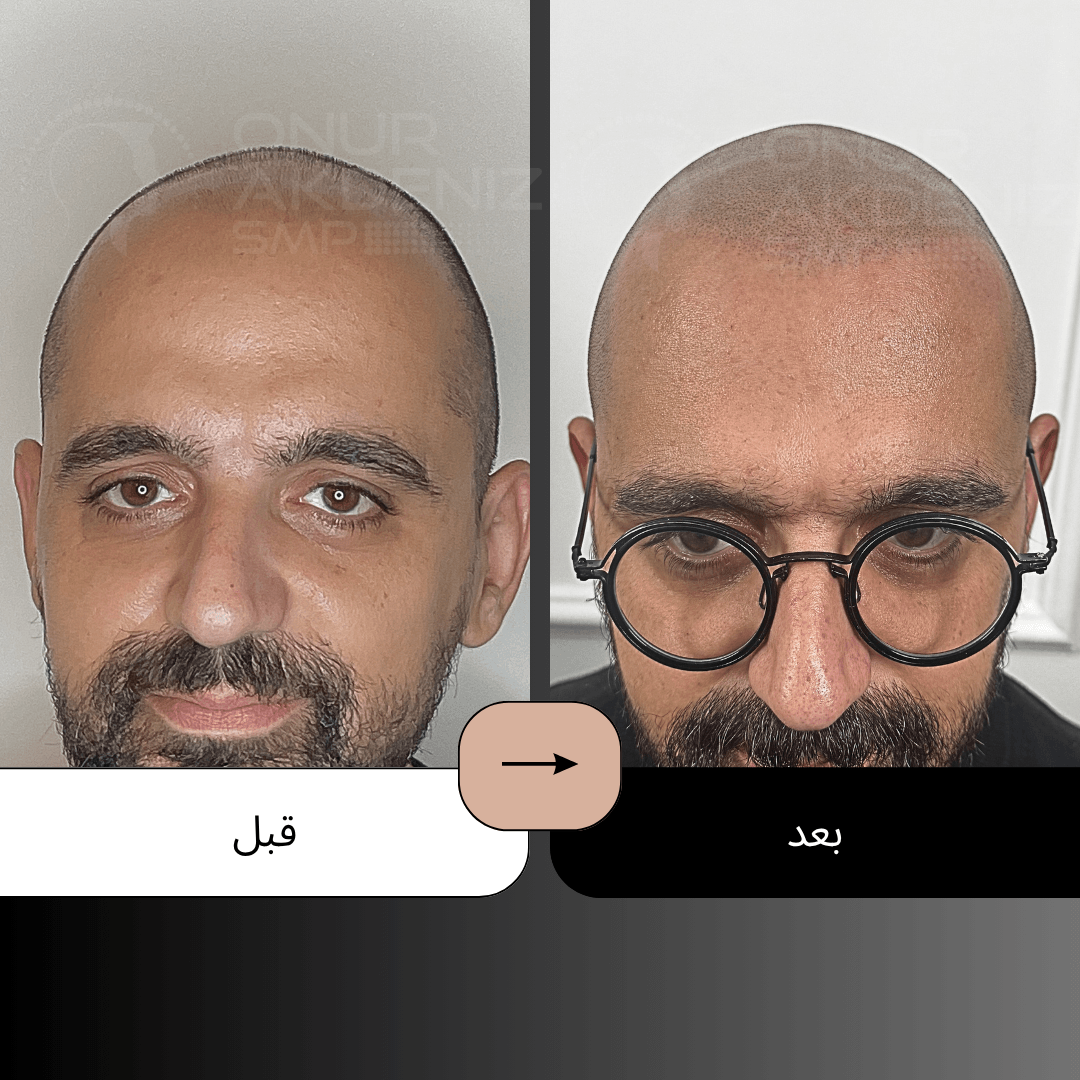 تصبغ فروة الرأس المجهري قبل وبعد للحصول على مظهر الشعر المحلوق مع أونور أكدينيز 132