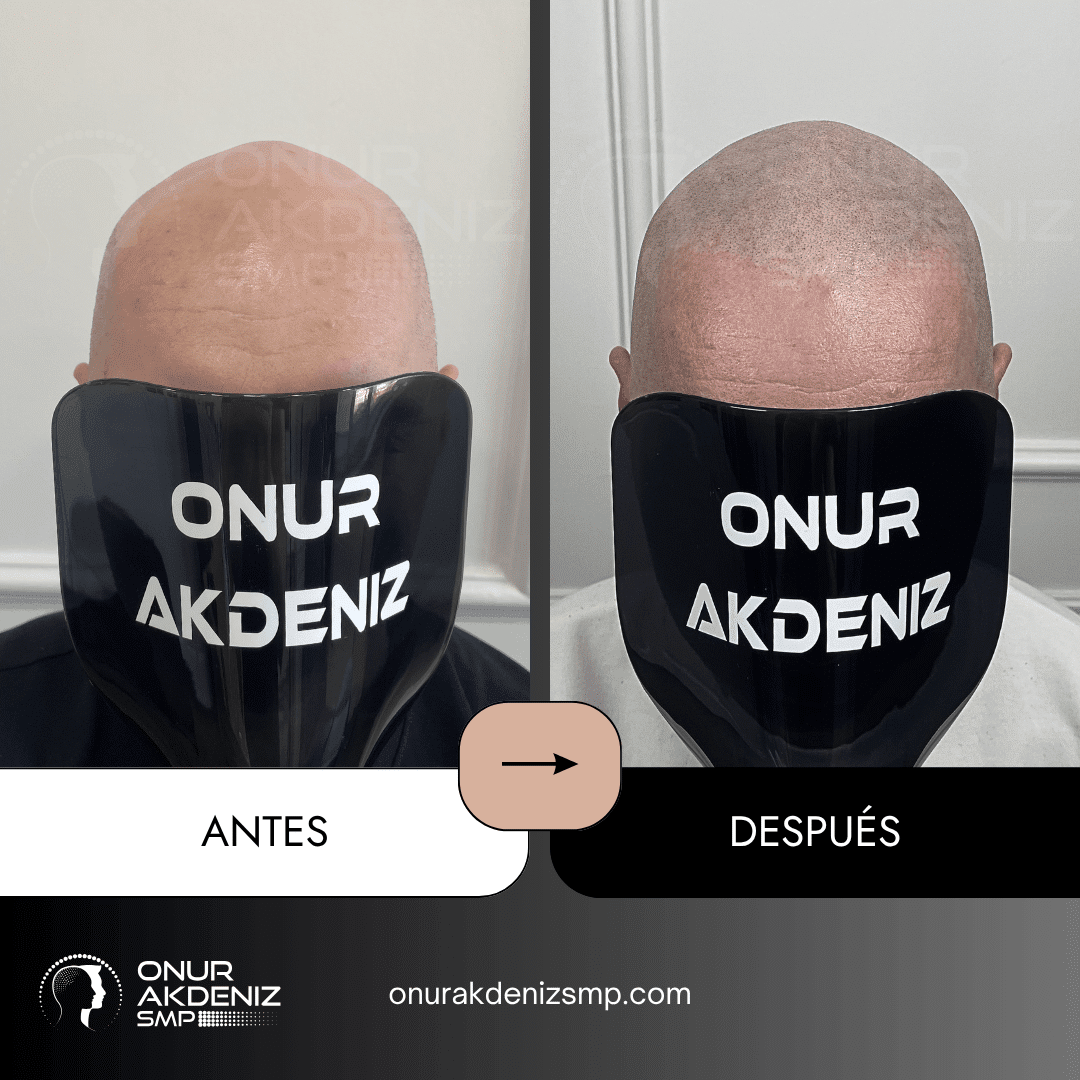 Antes y despues de la micropigmentacion del cuero cabelludo para un aspecto rapado – Onur Akdeniz Estambul Turquia 118