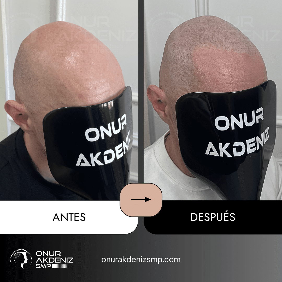 Antes y despues de la micropigmentacion del cuero cabelludo para un aspecto rapado – Onur Akdeniz Estambul Turquia 120