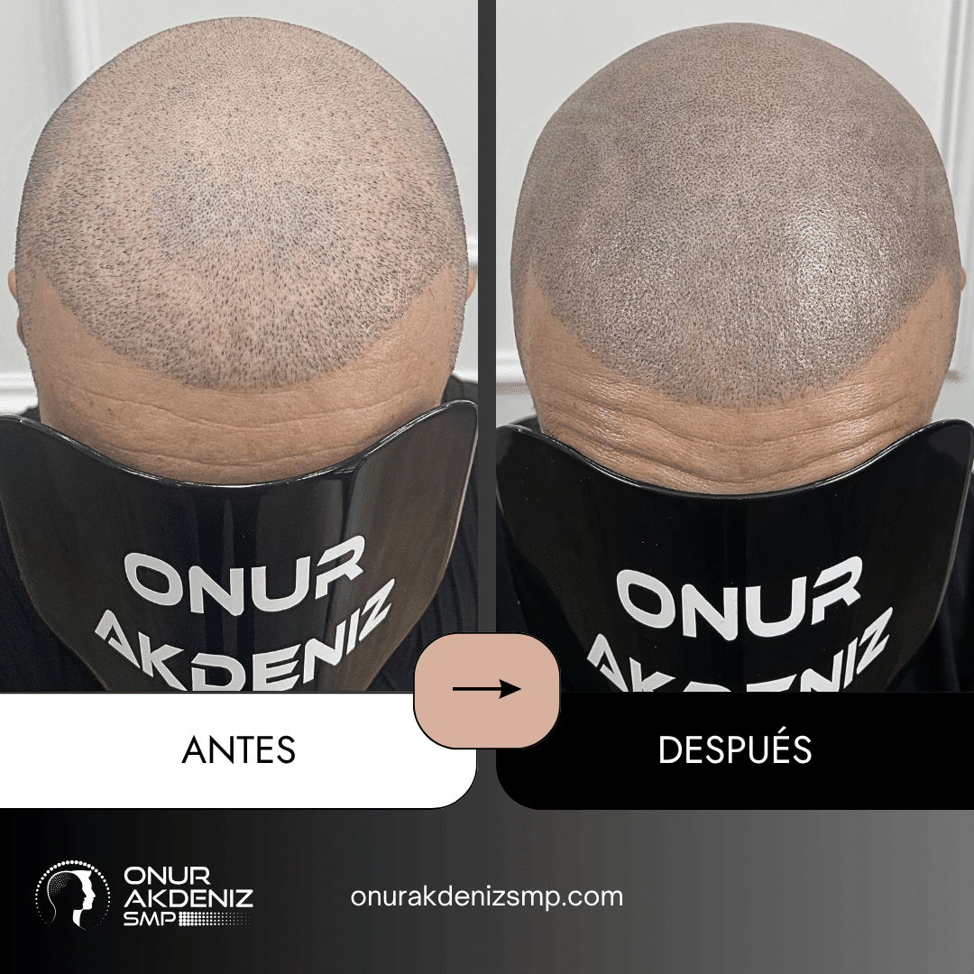 Antes y despues de la micropigmentacion del cuero cabelludo para un aspecto rapado – Onur Akdeniz Estambul Turquia 129
