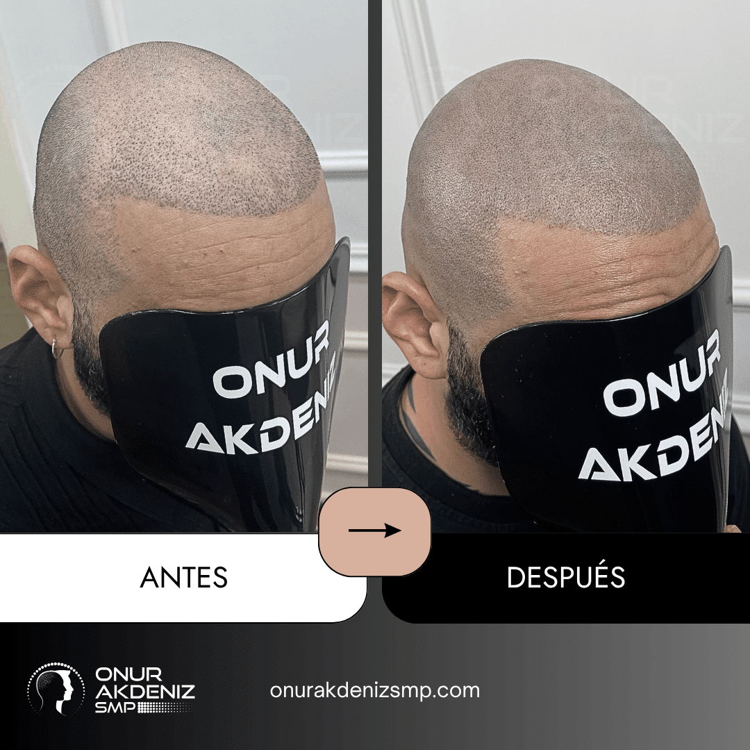 Antes y despues de la micropigmentacion del cuero cabelludo para un aspecto rapado – Onur Akdeniz Estambul Turquia 130