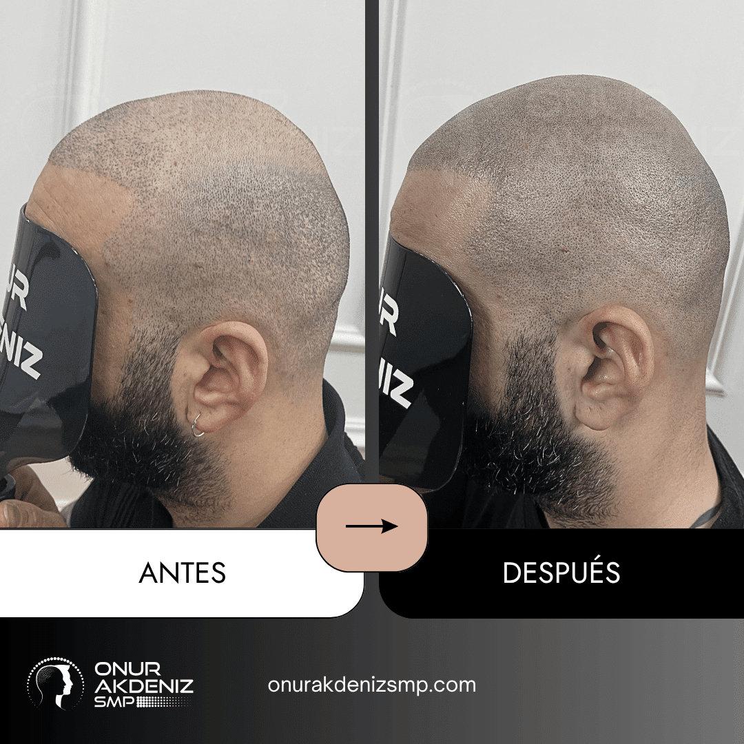 Antes y despues de la micropigmentacion del cuero cabelludo para un aspecto rapado – Onur Akdeniz Estambul Turquia 133