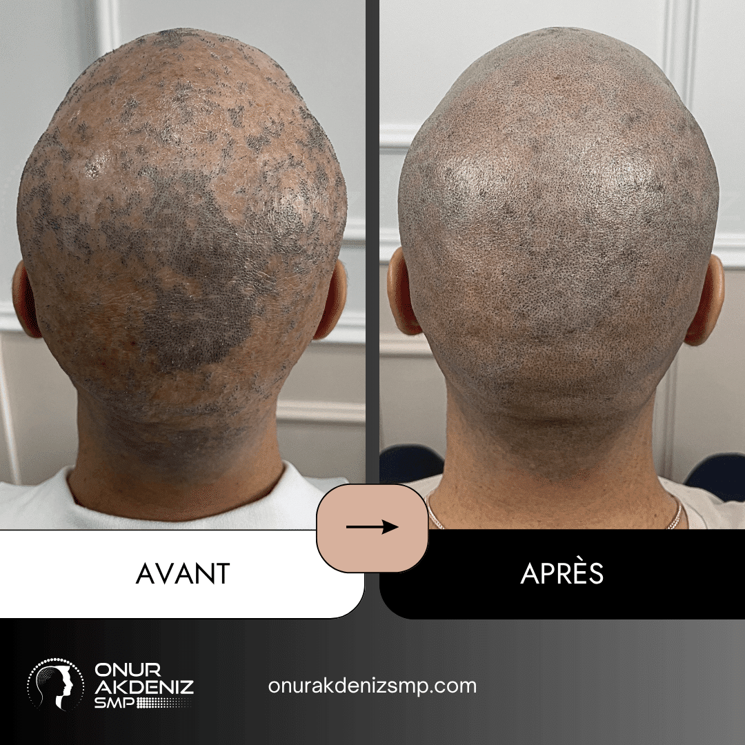 Avant apres de micropigmentation capillaire pour les patients atteints de lichen plan avec Onur Akdeniz SMP a Istanbul 7