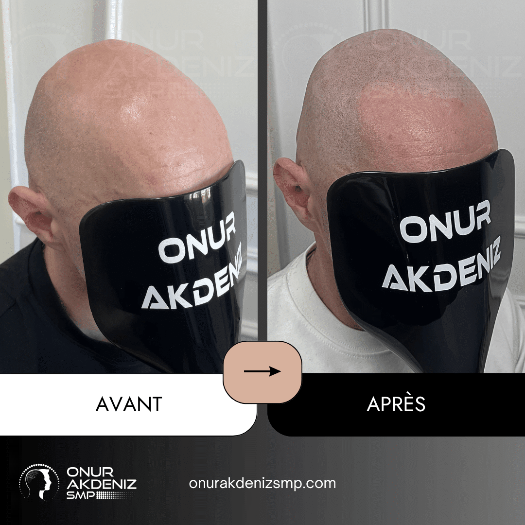 Avant et apres la micropigmentation du cuir chevelu pour un look rase – Onur Akdeniz Istanbul Turquie 120