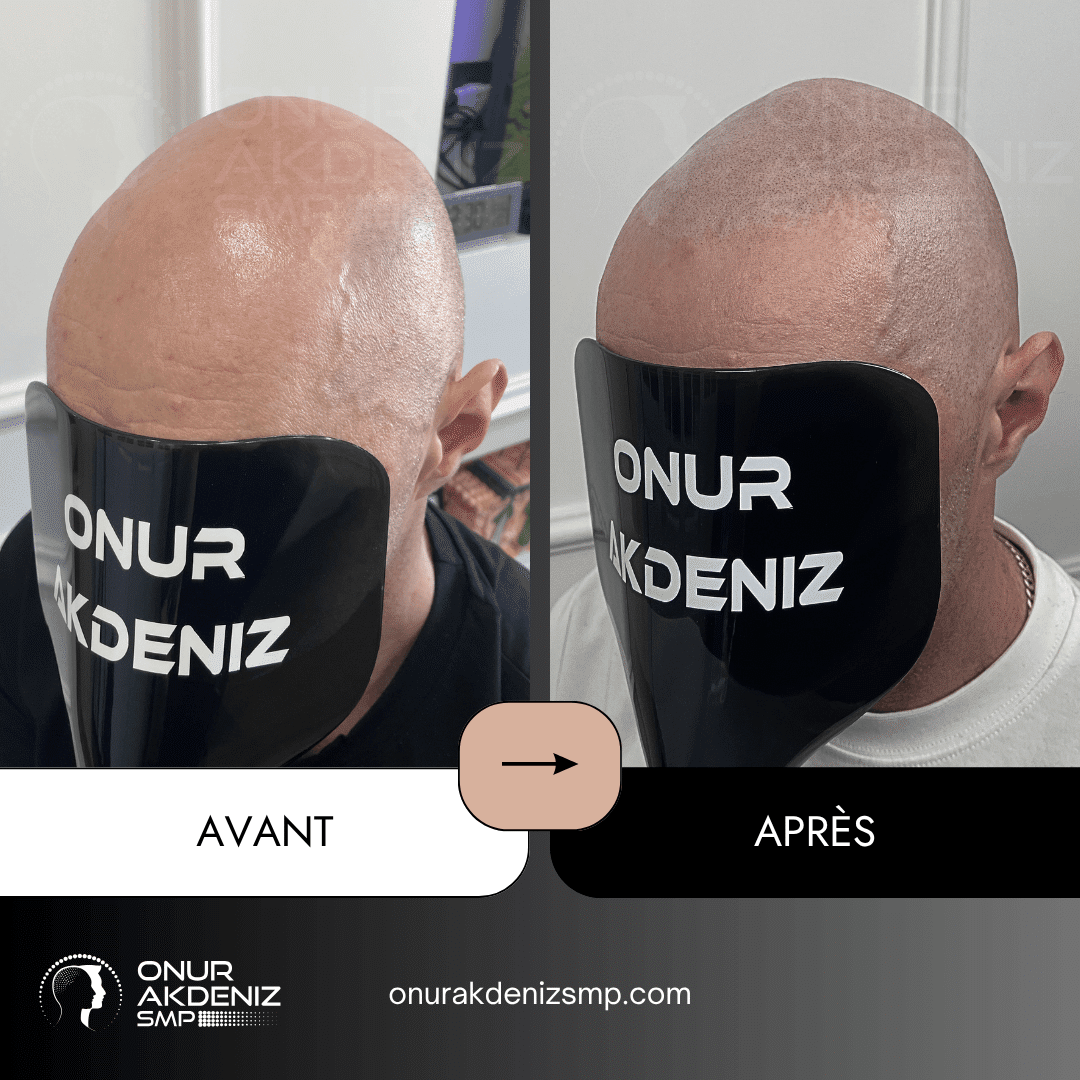 Avant et apres la micropigmentation du cuir chevelu pour un look rase – Onur Akdeniz Istanbul Turquie 121
