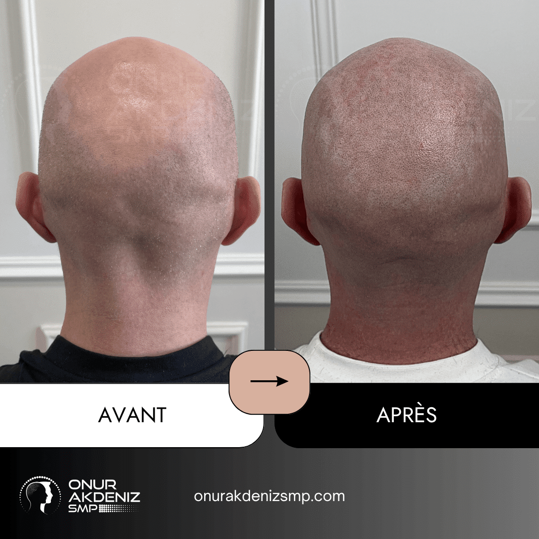 Avant et apres la micropigmentation du cuir chevelu pour un look rase – Onur Akdeniz Istanbul Turquie 124