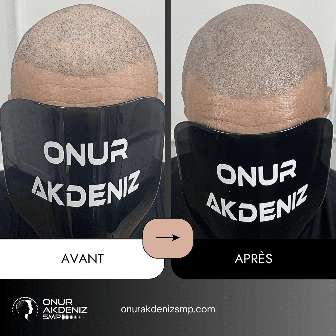 Avant et apres la micropigmentation du cuir chevelu pour un look rase – Onur Akdeniz Istanbul Turquie 125