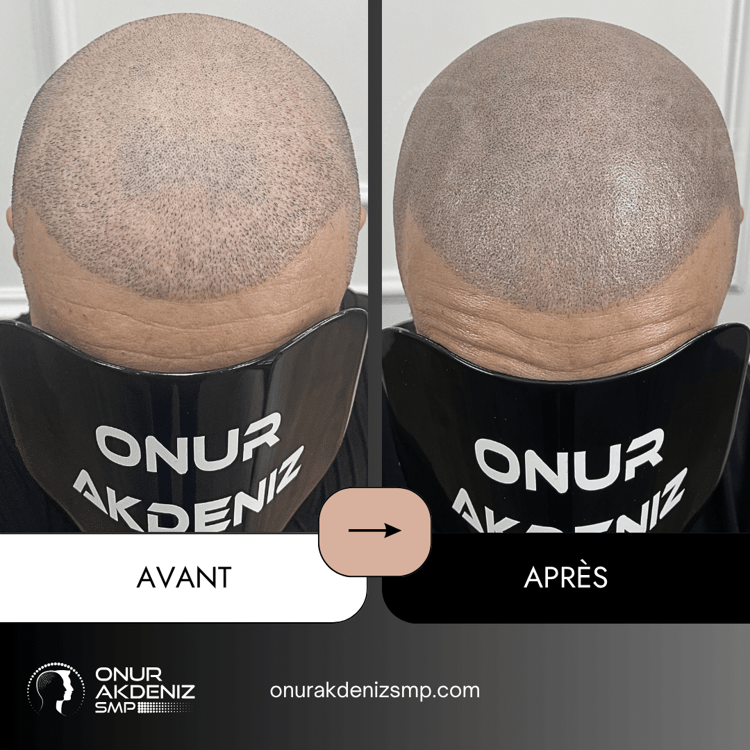 Avant et apres la micropigmentation du cuir chevelu pour un look rase – Onur Akdeniz Istanbul Turquie 126