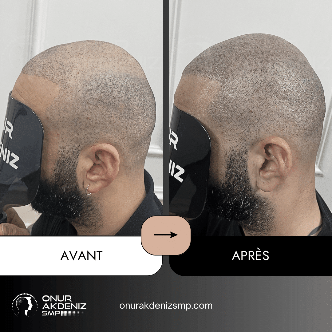 Avant et apres la micropigmentation du cuir chevelu pour un look rase – Onur Akdeniz Istanbul Turquie 130