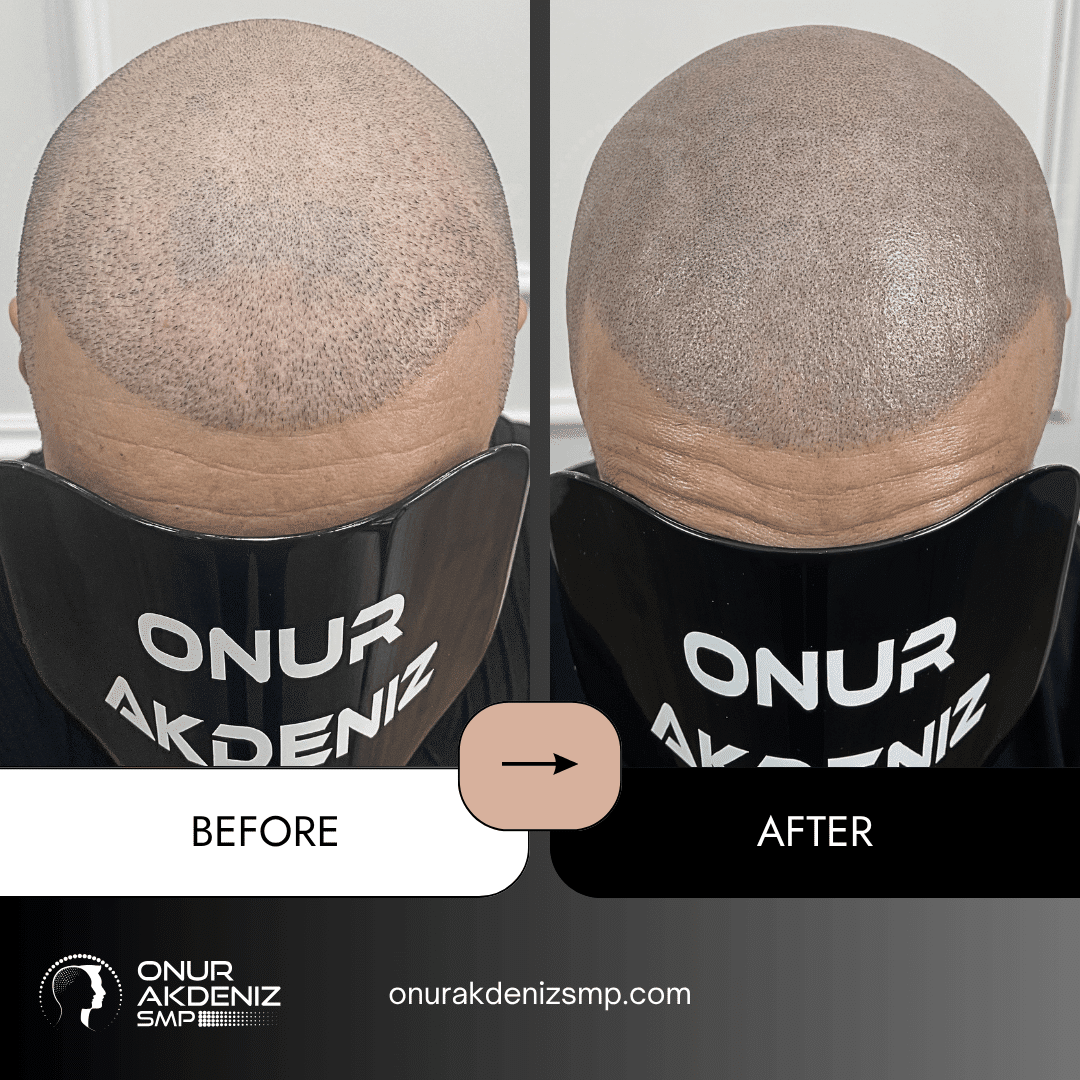 Before and After Scalp Micropigmentation for a Shaved Look Onur Akdeniz SMP Istanbul Turkey 129