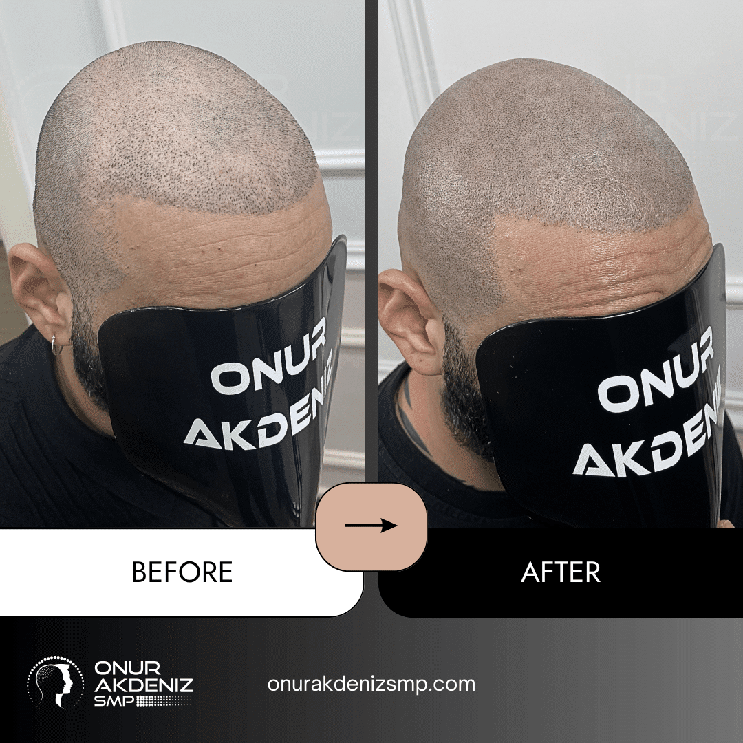 Before and After Scalp Micropigmentation for a Shaved Look Onur Akdeniz SMP Istanbul Turkey 130