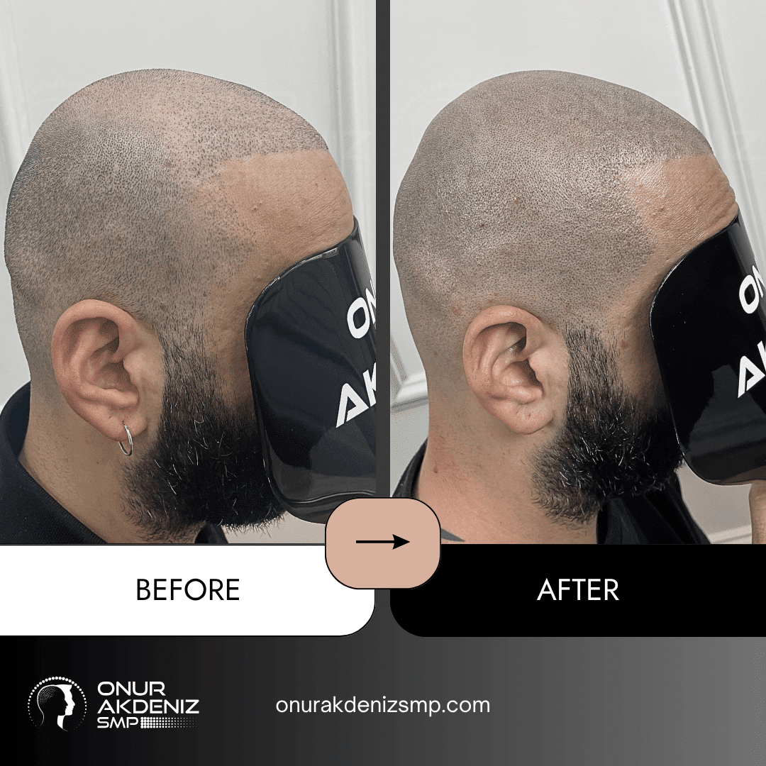 Before and After Scalp Micropigmentation for a Shaved Look Onur Akdeniz SMP Istanbul Turkey 132
