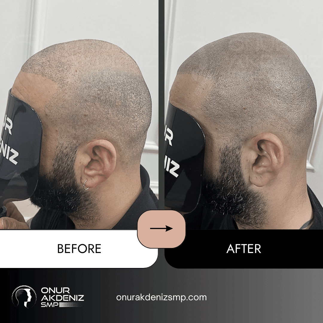 Before and After Scalp Micropigmentation for a Shaved Look Onur Akdeniz SMP Istanbul Turkey 133
