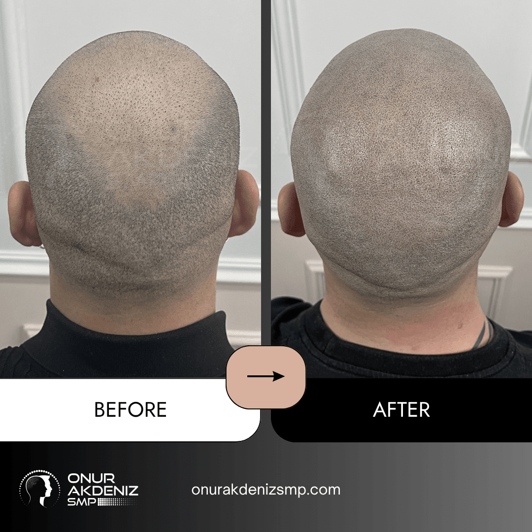Before and After Scalp Micropigmentation for a Shaved Look Onur Akdeniz SMP Istanbul Turkey 134
