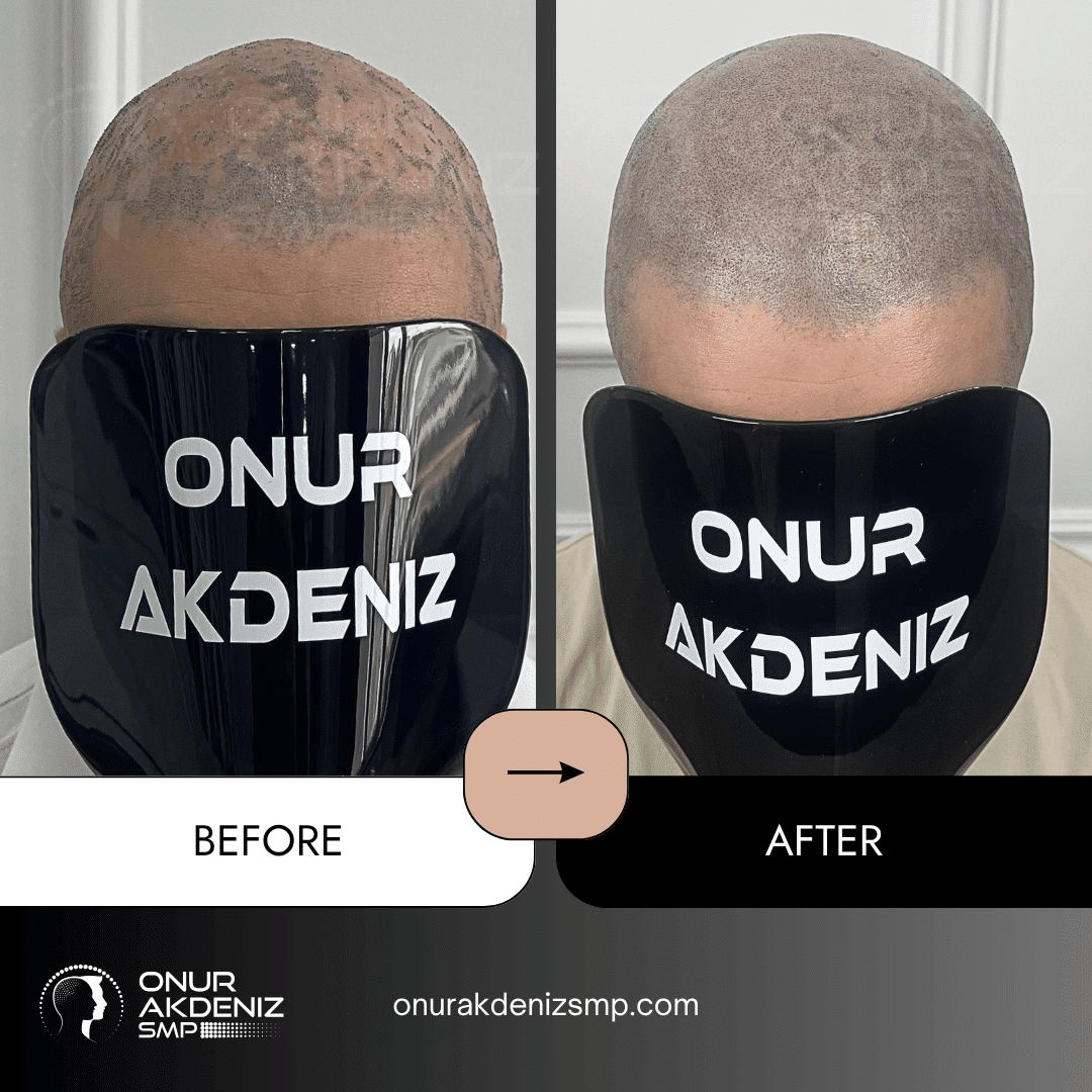 Before and after hair micropigmentation for Lichen Planus patients with Onur Akdeniz SMP in Istanbul 1