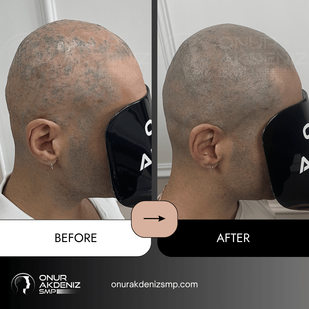 Before and after hair micropigmentation for Lichen Planus patients with Onur Akdeniz SMP in Istanbul 5