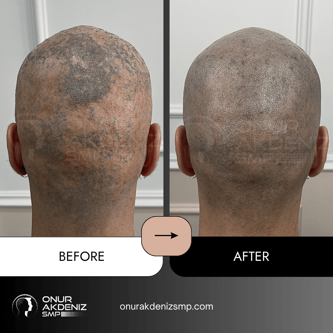 Before and after hair micropigmentation for Lichen Planus patients with Onur Akdeniz SMP in Istanbul 8