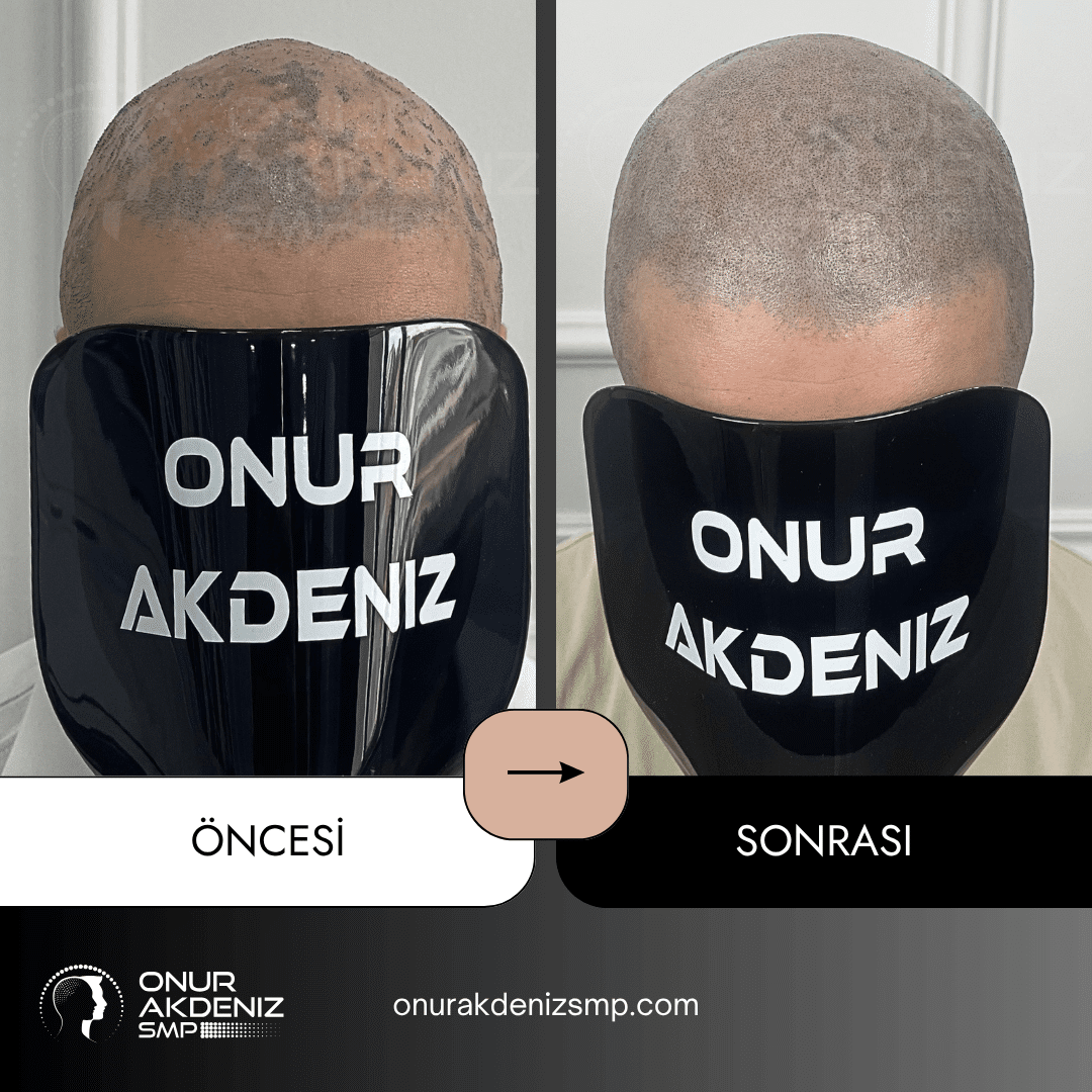 Istanbulda Onur Akdeniz SMP ile Likon Planus hastalari icin sac mikropigmentasyonu oncesi ve sonrasi 1