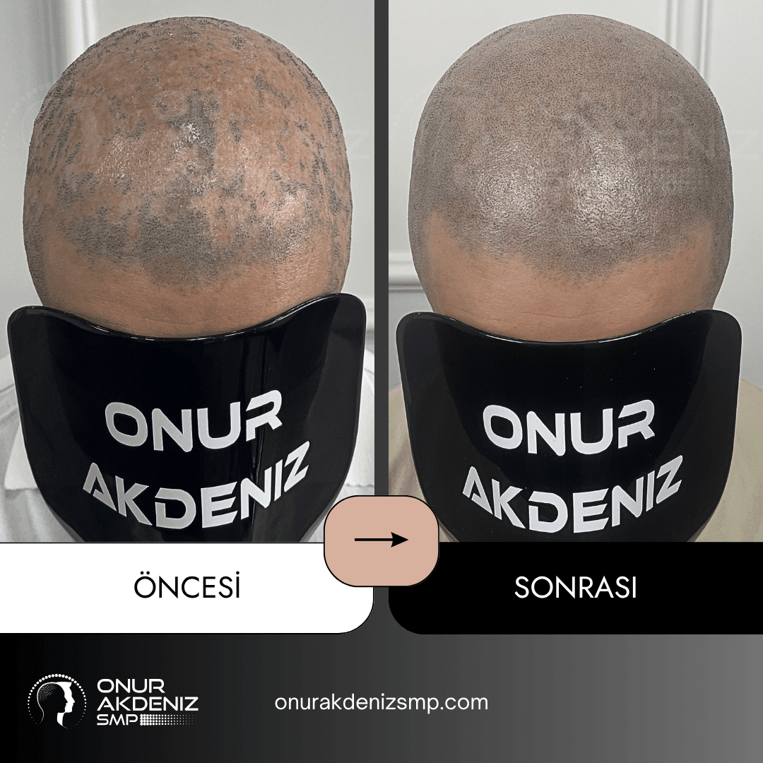 Istanbulda Onur Akdeniz SMP ile Likon Planus hastalari icin sac mikropigmentasyonu oncesi ve sonrasi 2
