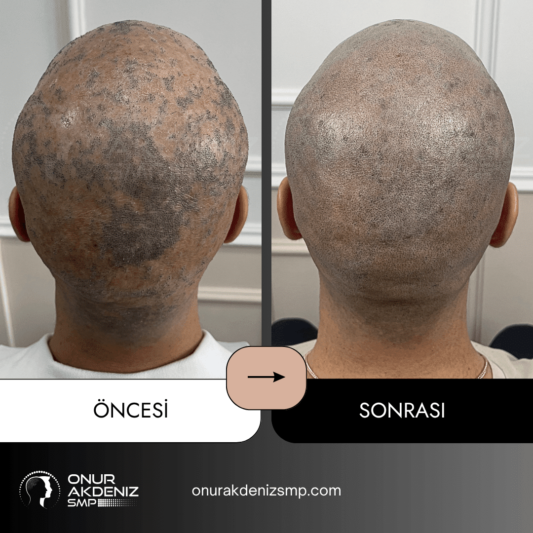 Istanbulda Onur Akdeniz SMP ile Likon Planus hastalari icin sac mikropigmentasyonu oncesi ve sonrasi 7