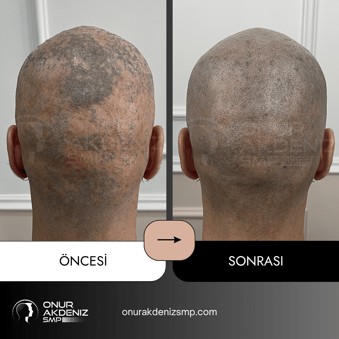 Istanbulda Onur Akdeniz SMP ile Likon Planus hastalari icin sac mikropigmentasyonu oncesi ve sonrasi 8