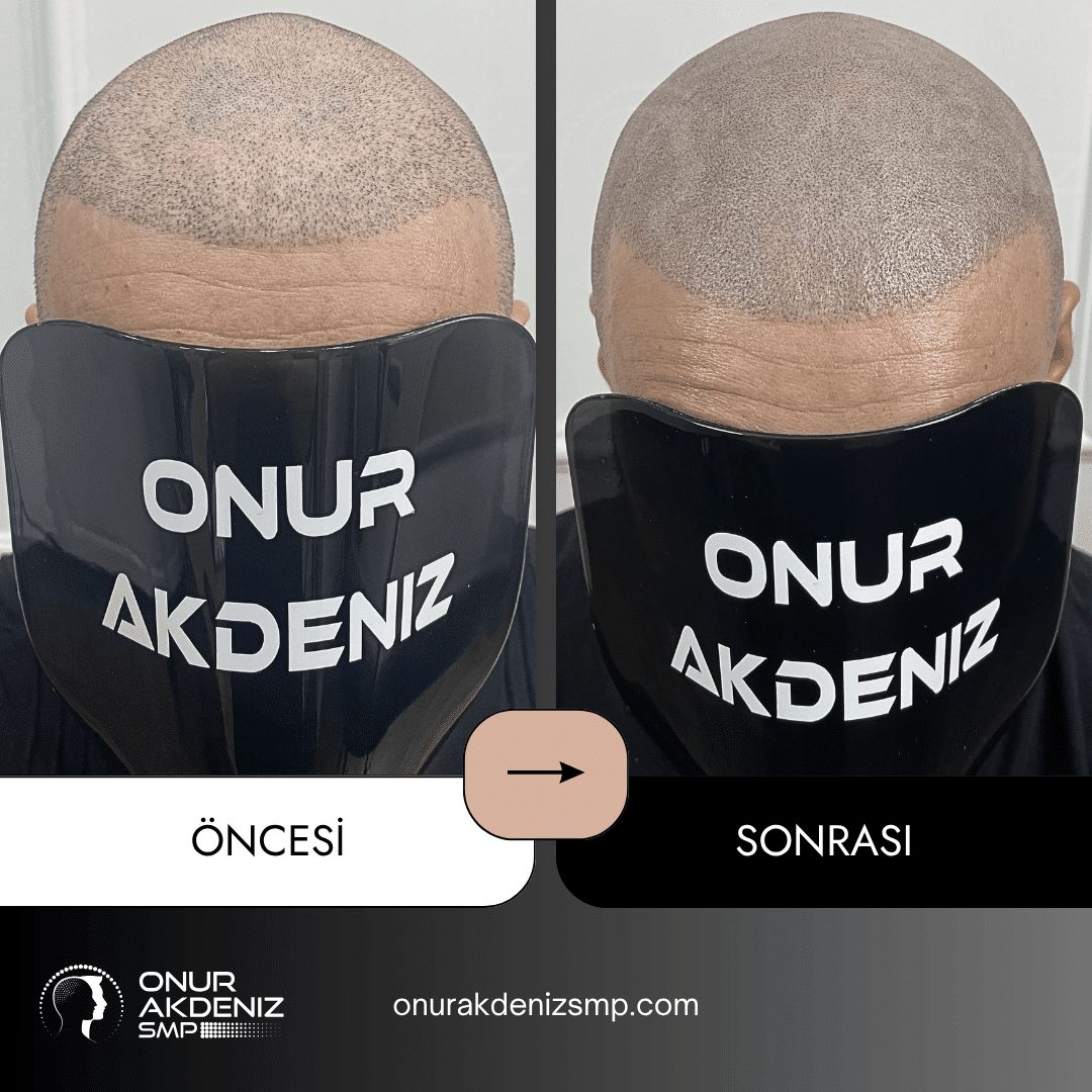 Onur Akdeniz SMP tarafindan tirasli sac gorunumu icin sac mikropigmentasyonu oncesi ve sonrasi 127