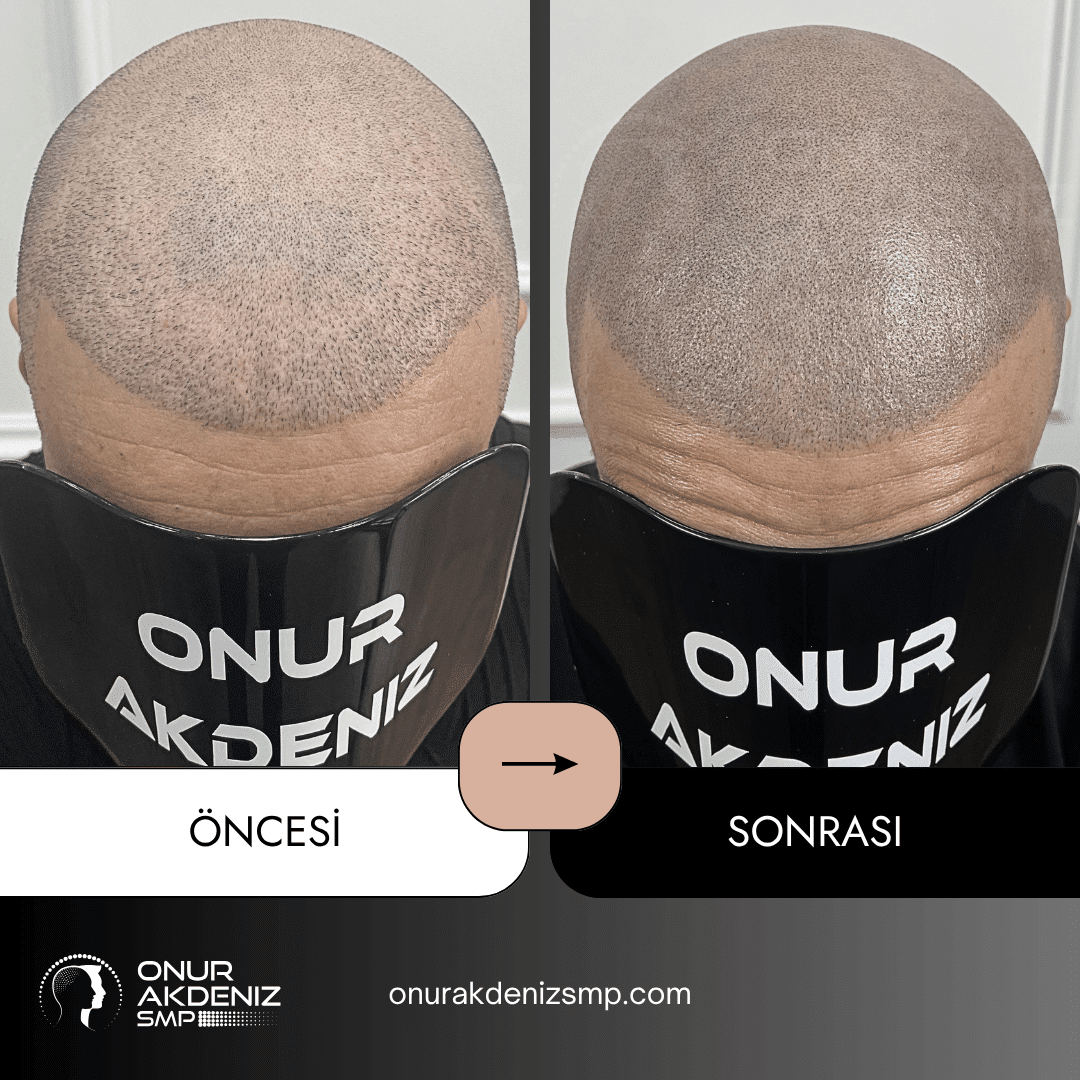 Onur Akdeniz SMP tarafindan tirasli sac gorunumu icin sac mikropigmentasyonu oncesi ve sonrasi 128