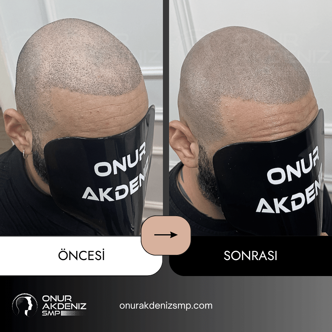 Onur Akdeniz SMP tarafindan tirasli sac gorunumu icin sac mikropigmentasyonu oncesi ve sonrasi 129