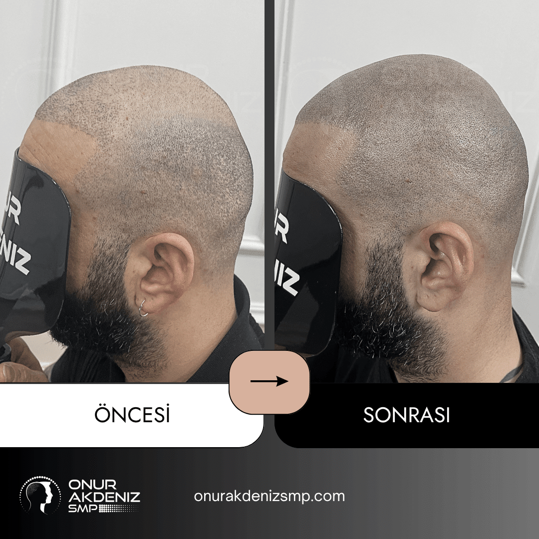 Onur Akdeniz SMP tarafindan tirasli sac gorunumu icin sac mikropigmentasyonu oncesi ve sonrasi 132