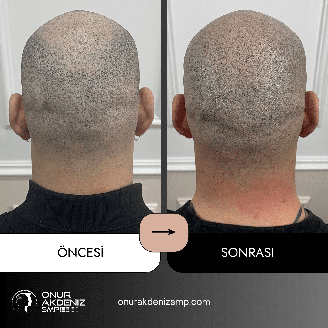 Onur Akdeniz SMP tarafindan tirasli sac gorunumu icin sac mikropigmentasyonu oncesi ve sonrasi 134