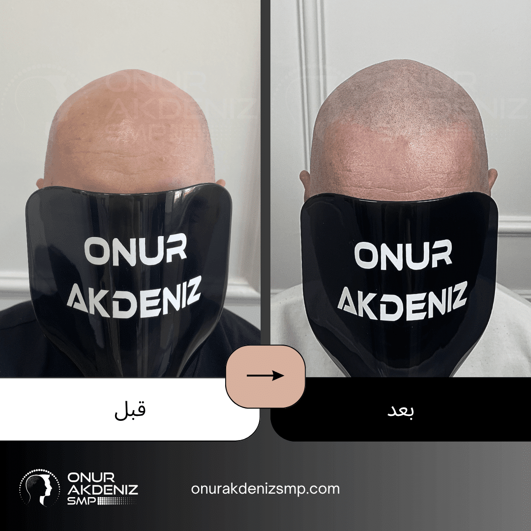 تصبغ فروة الرأس المجهري قبل وبعد للحصول على مظهر الشعر المحلوق مع أونور أكدينيز 117