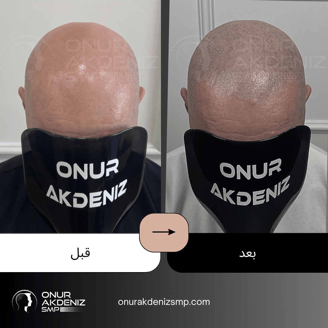 تصبغ فروة الرأس المجهري قبل وبعد للحصول على مظهر الشعر المحلوق مع أونور أكدينيز 118