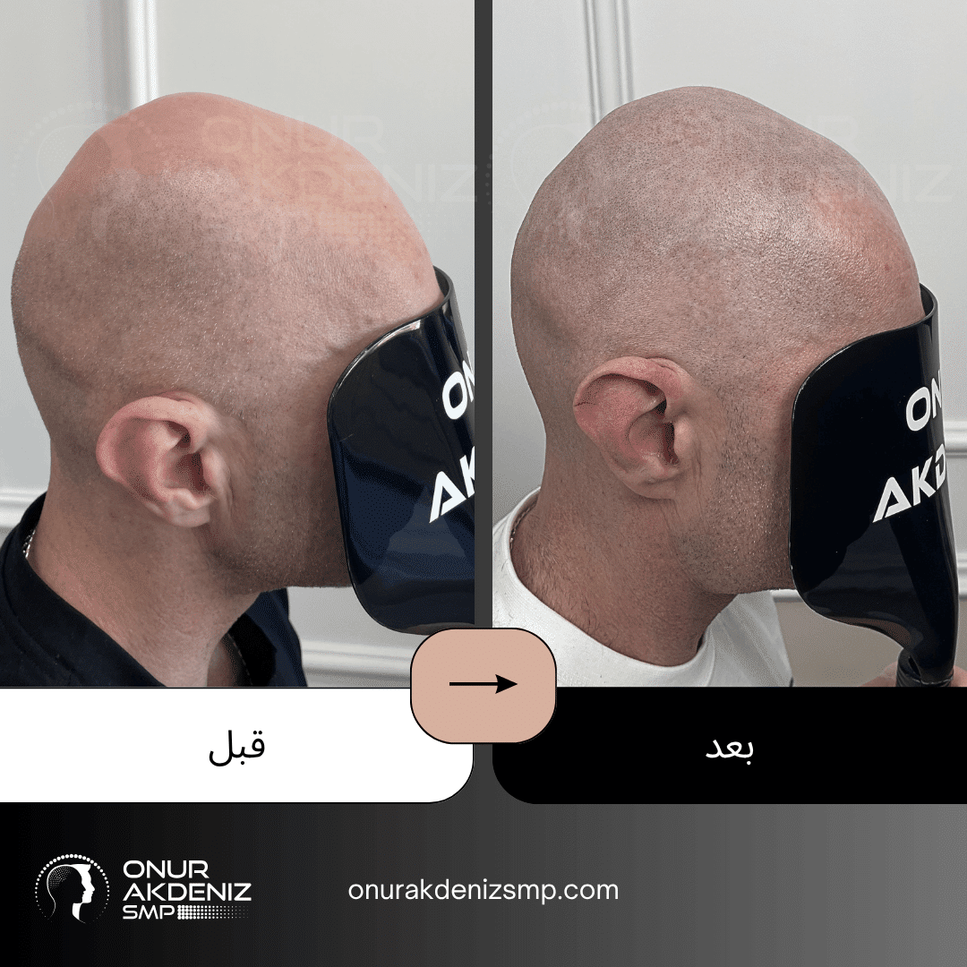 تصبغ فروة الرأس المجهري قبل وبعد للحصول على مظهر الشعر المحلوق مع أونور أكدينيز 121