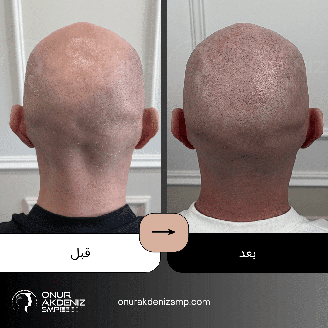 تصبغ فروة الرأس المجهري قبل وبعد للحصول على مظهر الشعر المحلوق مع أونور أكدينيز 123