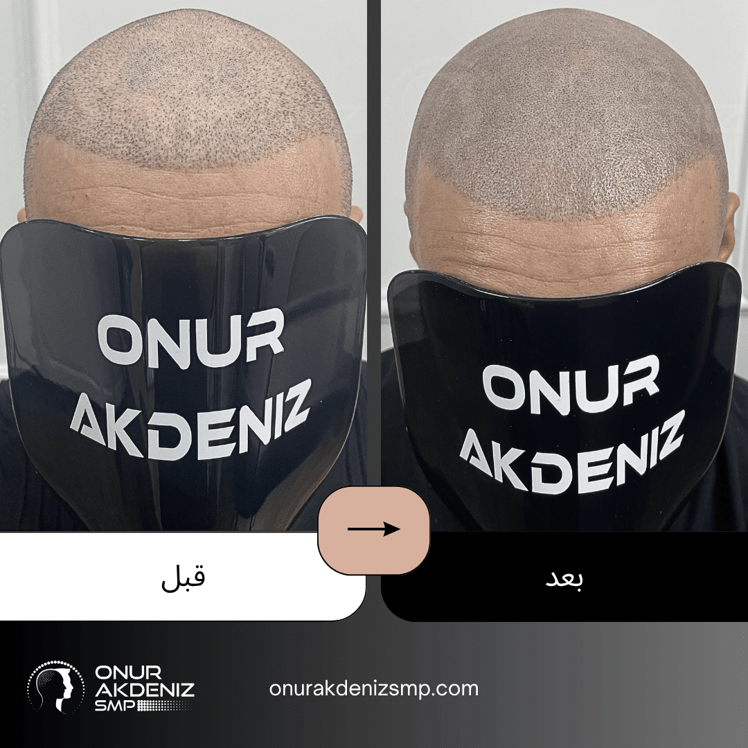 تصبغ فروة الرأس المجهري قبل وبعد للحصول على مظهر الشعر المحلوق مع أونور أكدينيز 127