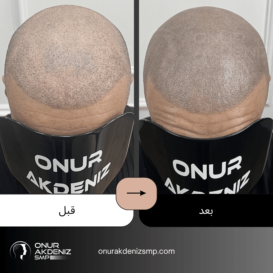 تصبغ فروة الرأس المجهري قبل وبعد للحصول على مظهر الشعر المحلوق مع أونور أكدينيز 128