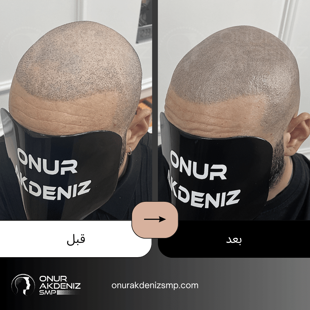 تصبغ فروة الرأس المجهري قبل وبعد للحصول على مظهر الشعر المحلوق مع أونور أكدينيز 130