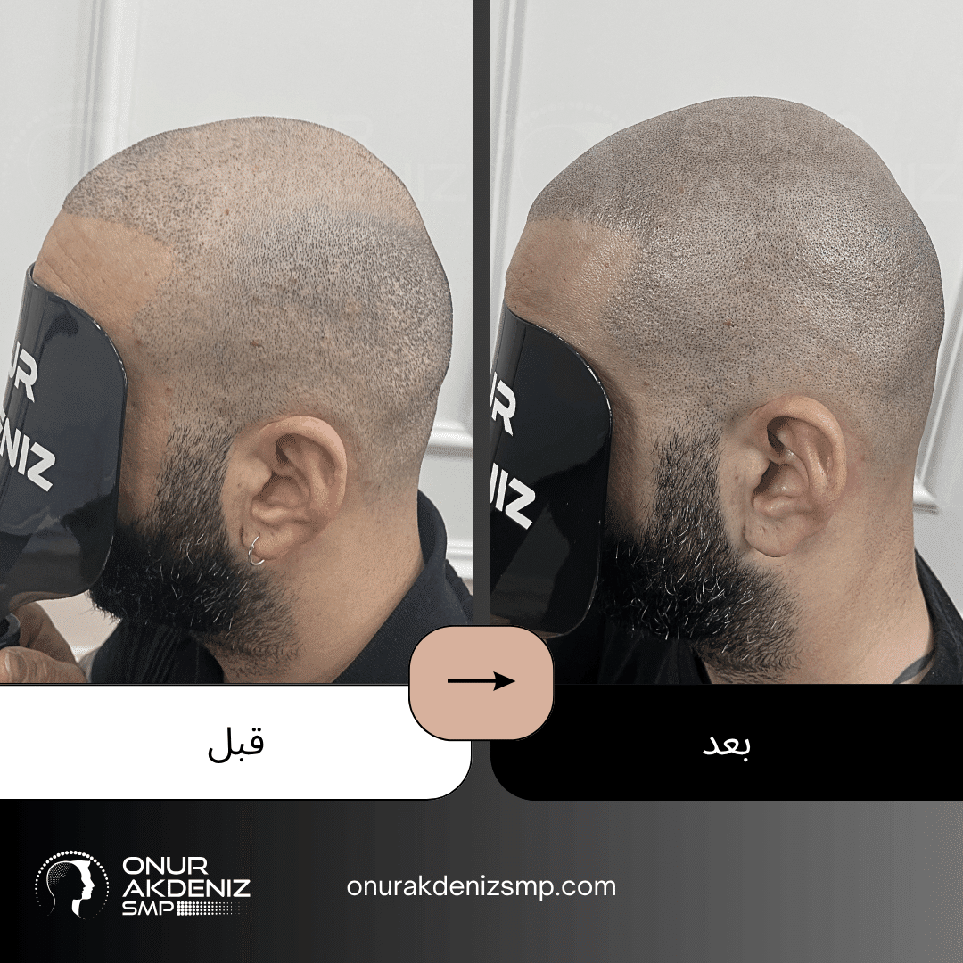 تصبغ فروة الرأس المجهري قبل وبعد للحصول على مظهر الشعر المحلوق مع أونور أكدينيز 132