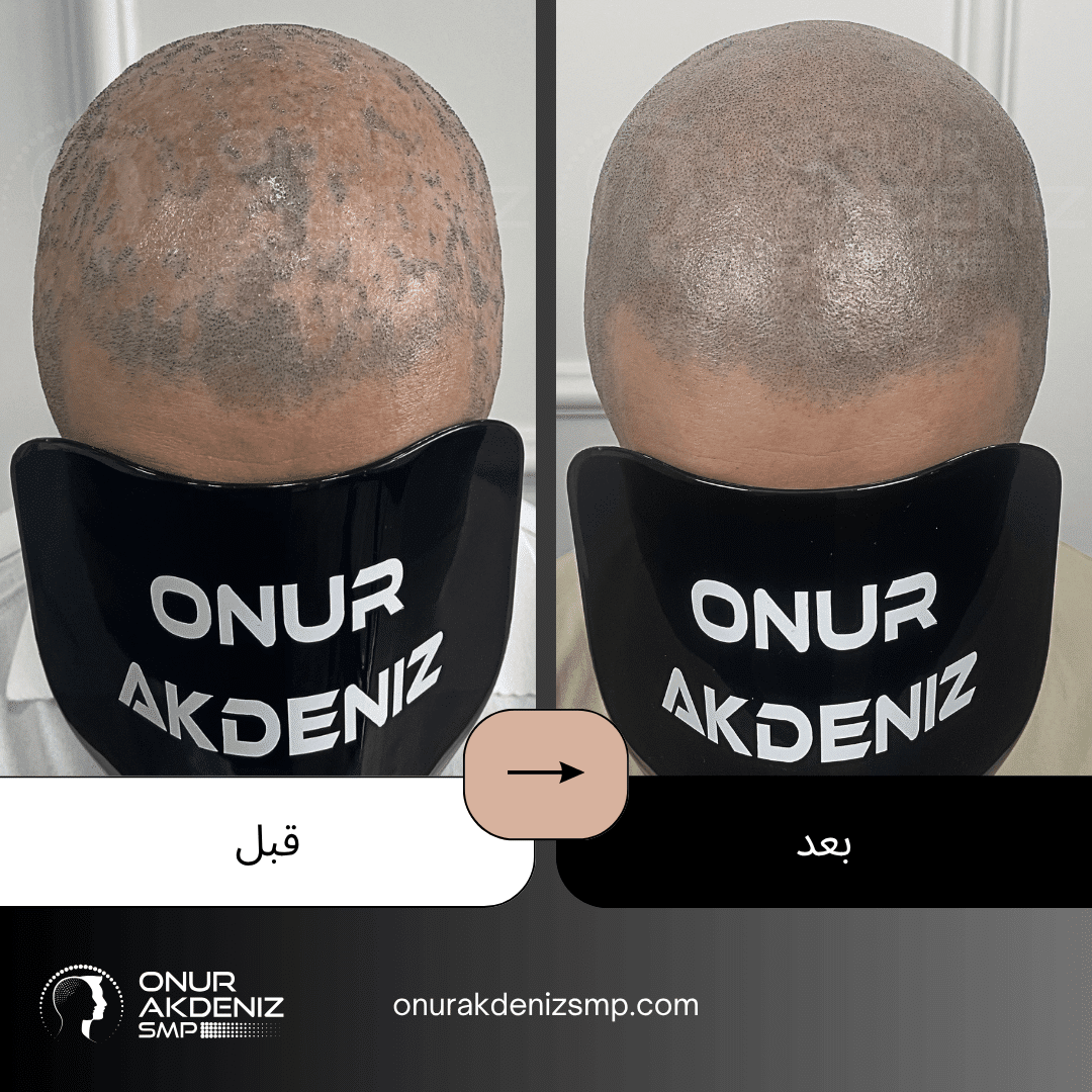 قبل وبعد الصبغ المجهري لفروة الرأس لمرضى الحزاز المستوي مع أونور أقدينيز SMP في إسطنبول 2