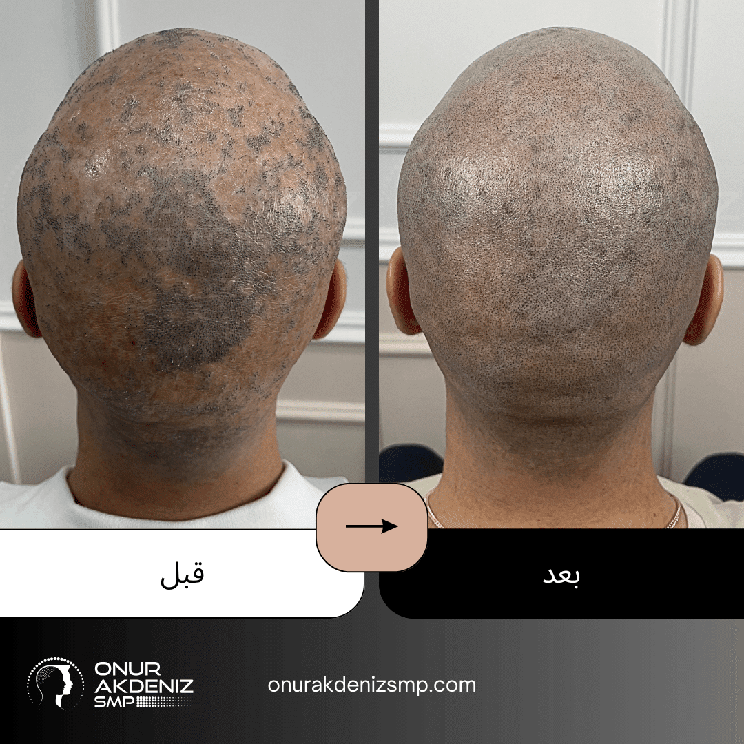 قبل وبعد الصبغ المجهري لفروة الرأس لمرضى الحزاز المستوي مع أونور أقدينيز SMP في إسطنبول 7