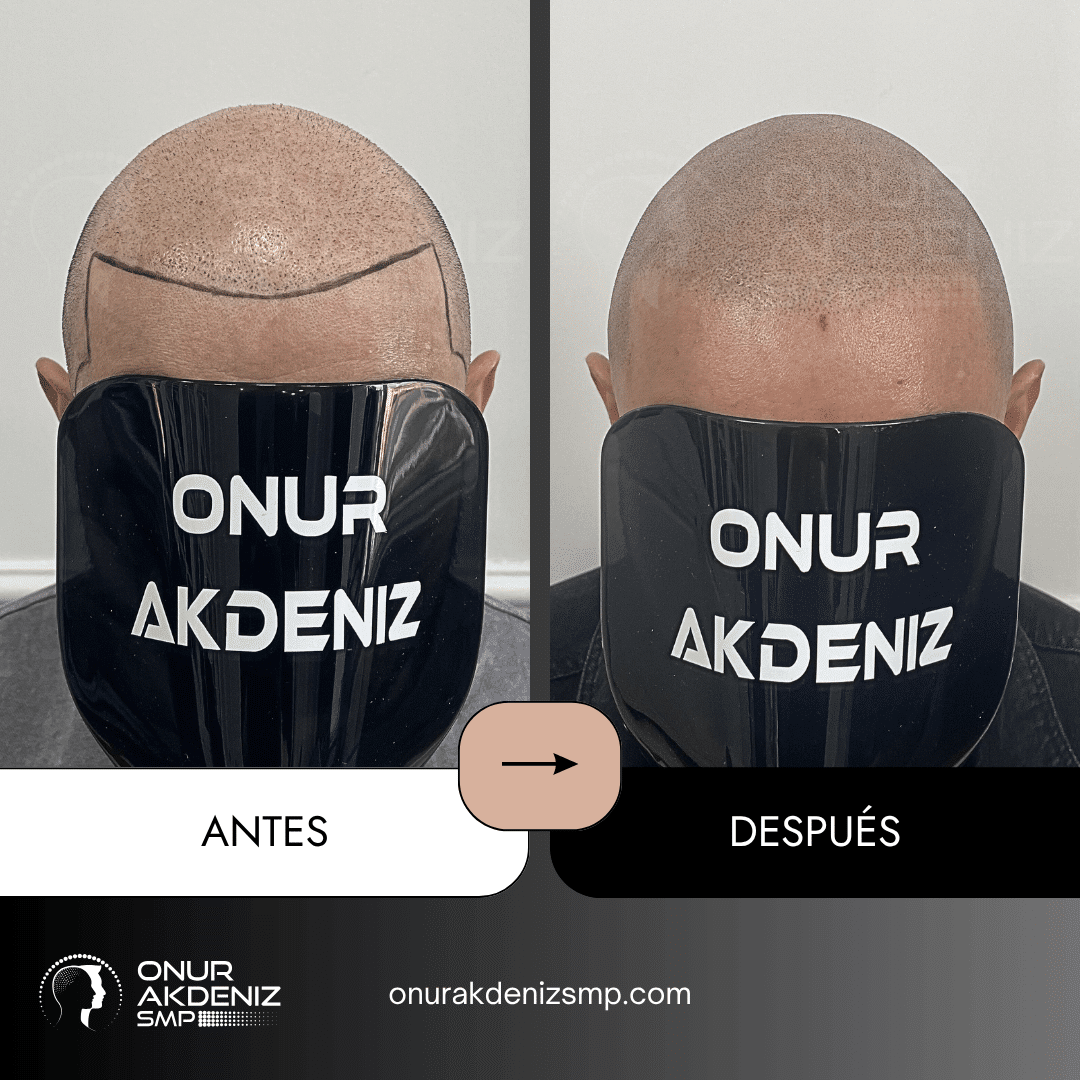 Antes y despues de la micropigmentacion del cuero cabelludo para un aspecto rapado – Onur Akdeniz Estambul Turquia 136