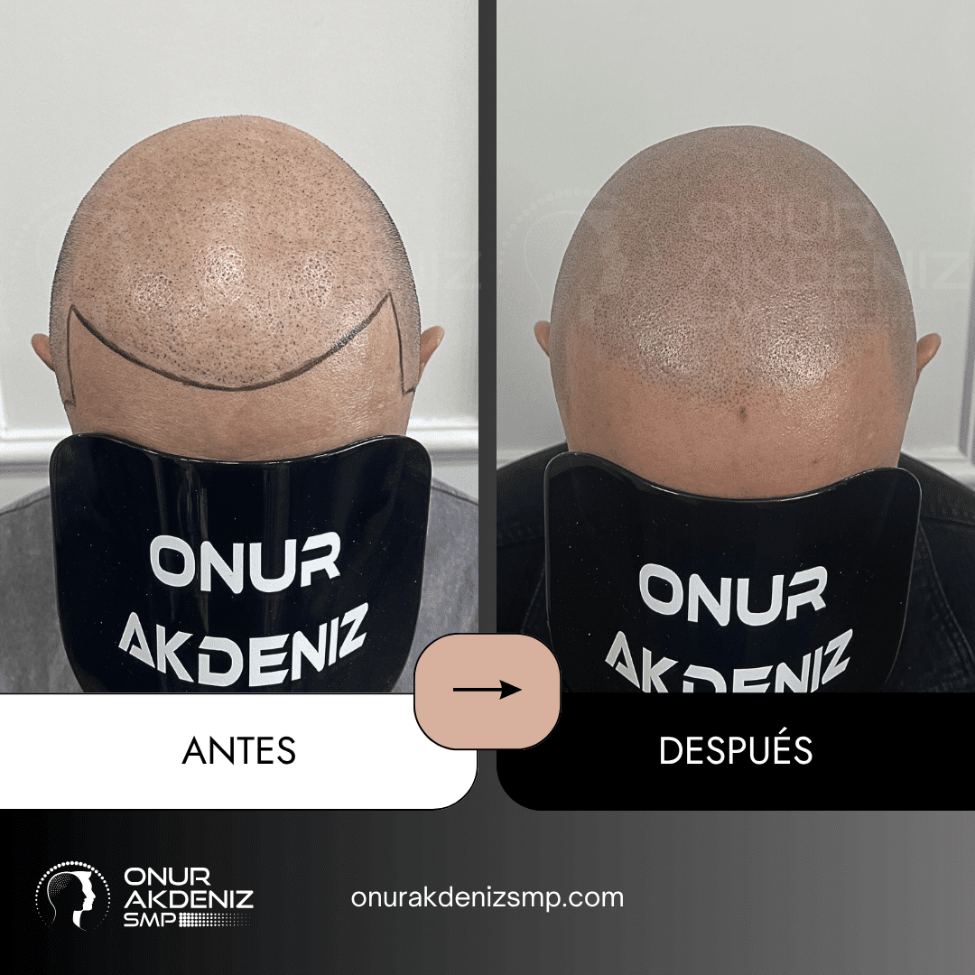 Antes y despues de la micropigmentacion del cuero cabelludo para un aspecto rapado – Onur Akdeniz Estambul Turquia 137