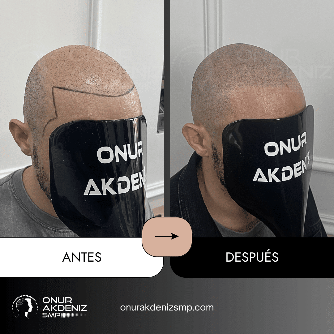 Antes y despues de la micropigmentacion del cuero cabelludo para un aspecto rapado – Onur Akdeniz Estambul Turquia 138